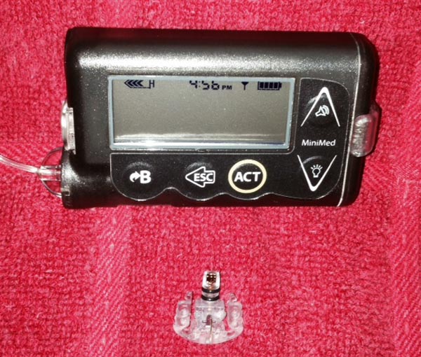 Pump-and-CGM